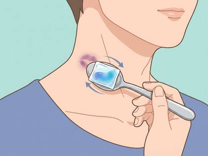 首のキスマークをスプーンの氷で冷やすイラスト。