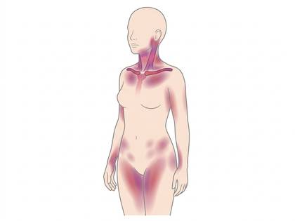 女性の全身図。首、肩、胸、腕、胴、股関節、太ももに赤紫色の着色で症状部位を示している。